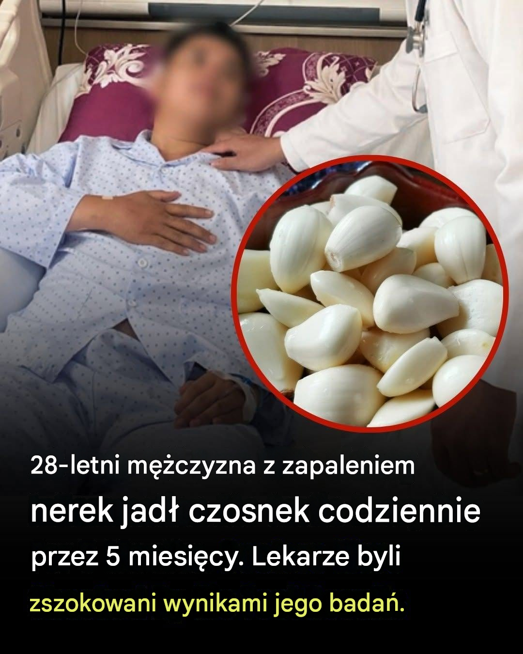 Jadł czosnek codziennie przez 5 miesięcy – to, co stało się z jego nerkami, zaskoczyło lekarzy