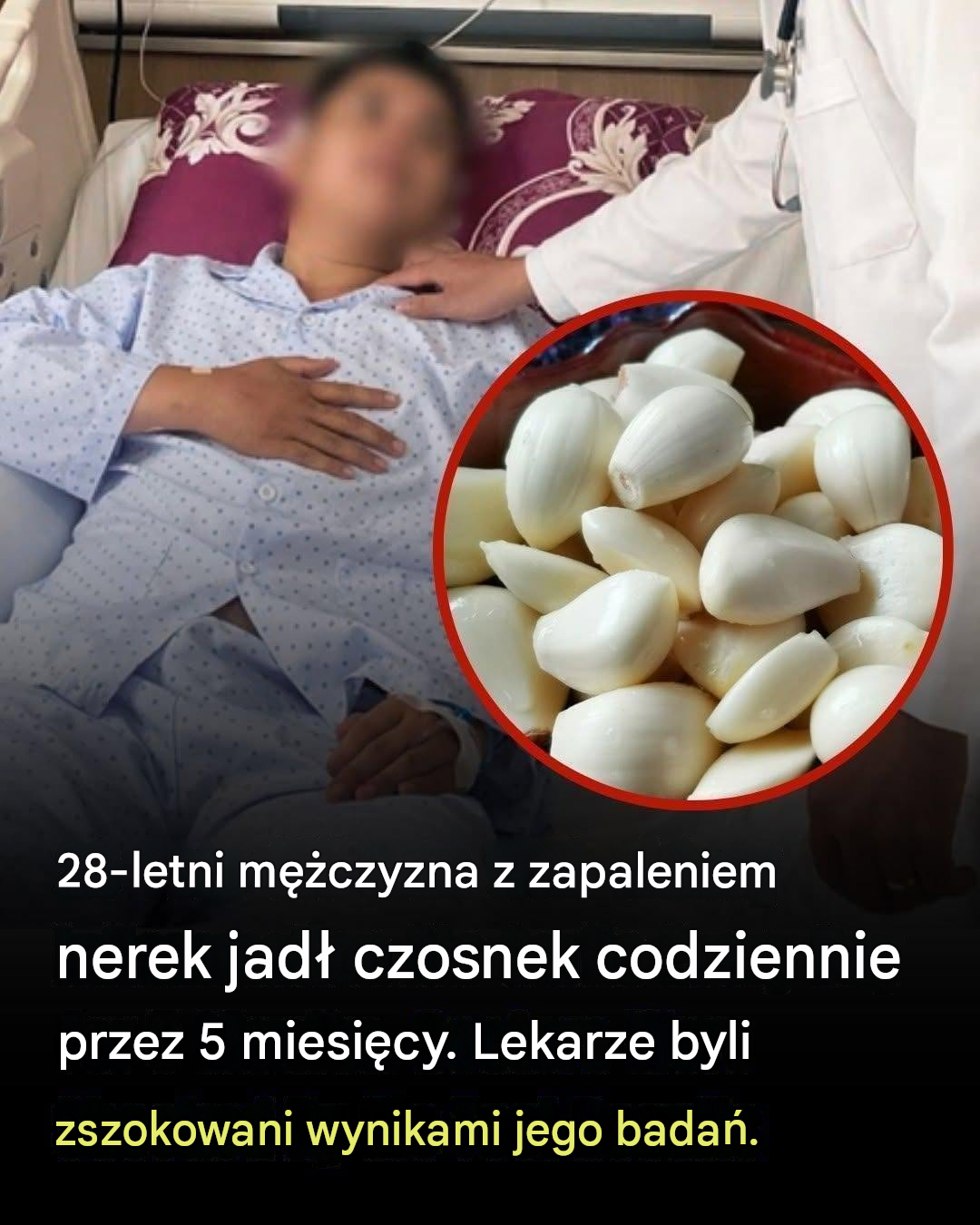 28-letni mężczyzna z zapaleniem nerek jadł czosnek codziennie przez 5 miesięcy – lekarze zaskoczeni wynikami