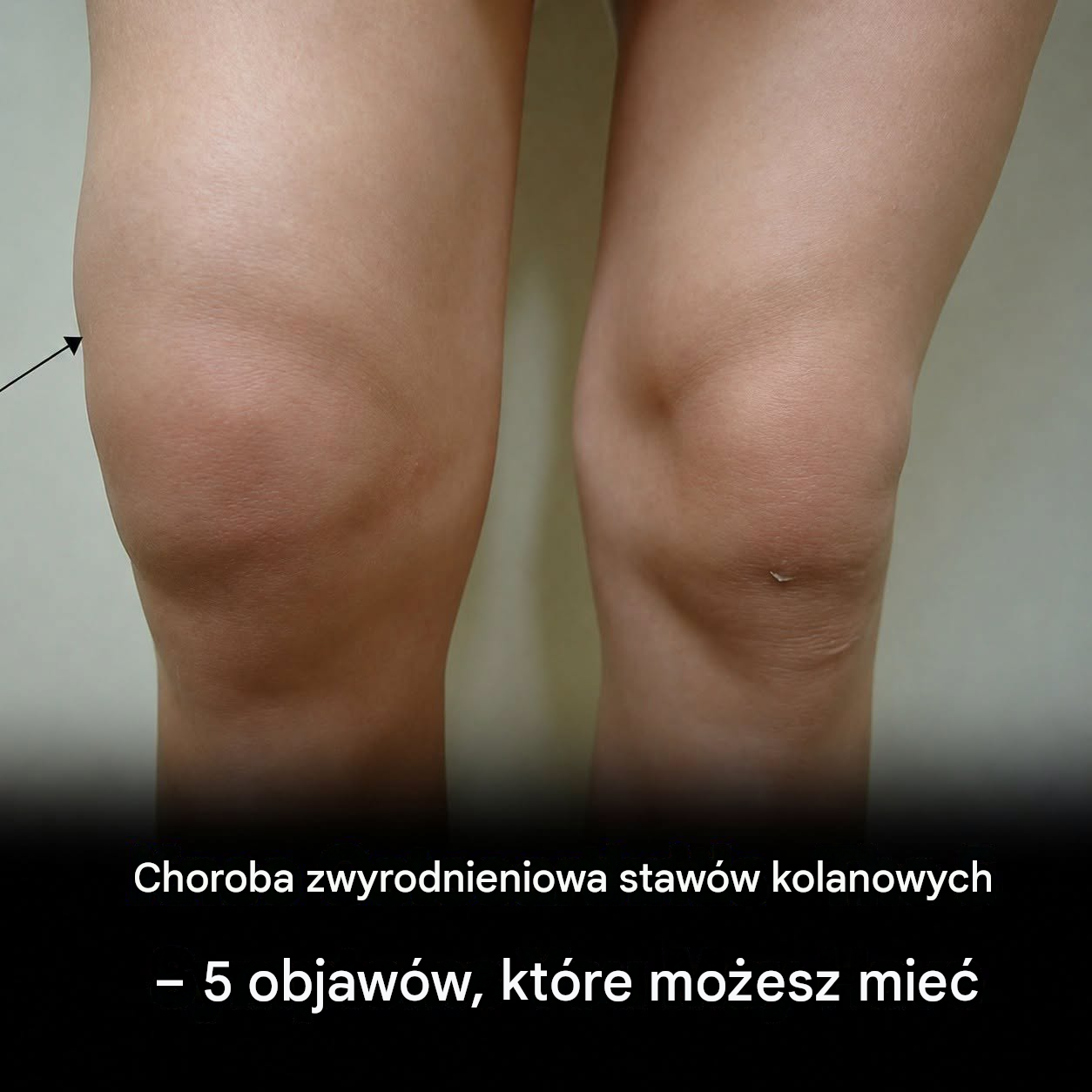 Ból czy sztywność kolana? Te 5 objawów może wskazywać na chorobę zwyrodnieniową stawów