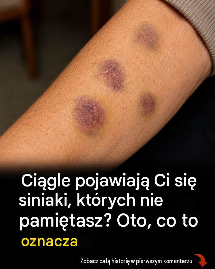 Niewyjaśnione siniaki na ciele: przyczyny i leczenie