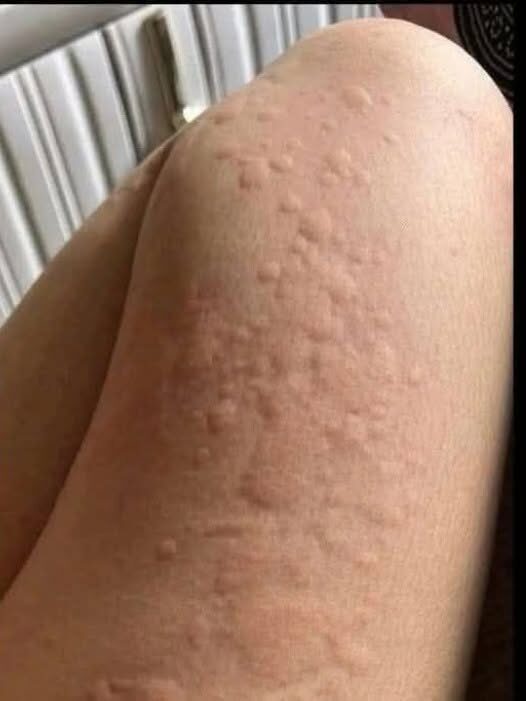 Myślał, że to tylko alergia — ale prawdziwa przyczyna zmieniła wszystko Myślał,