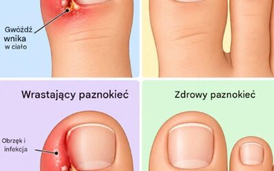 Wrastające paznokcie u stóp: Jak szybko i naturalnie sobie z nimi poradzić w domu