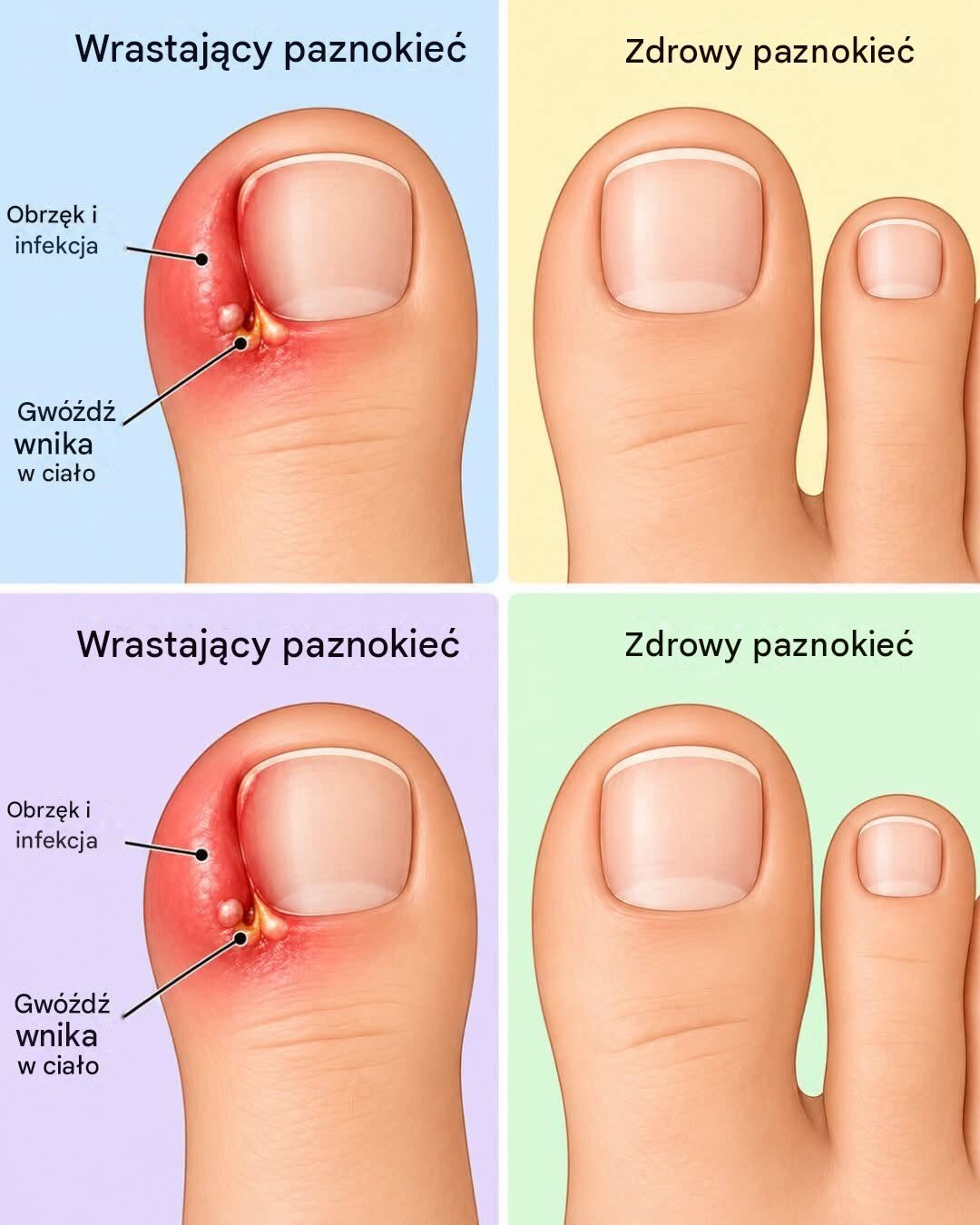 Wrastające paznokcie u stóp: Jak szybko i naturalnie sobie z nimi poradzić w domu