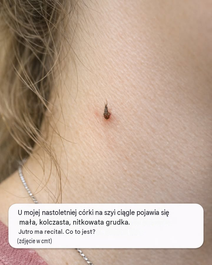 Mojej nastoletniej córce ciągle wyrasta na szyi ten kolczasty, nitkowaty guzek. Jutro ma recital. Co to jest?