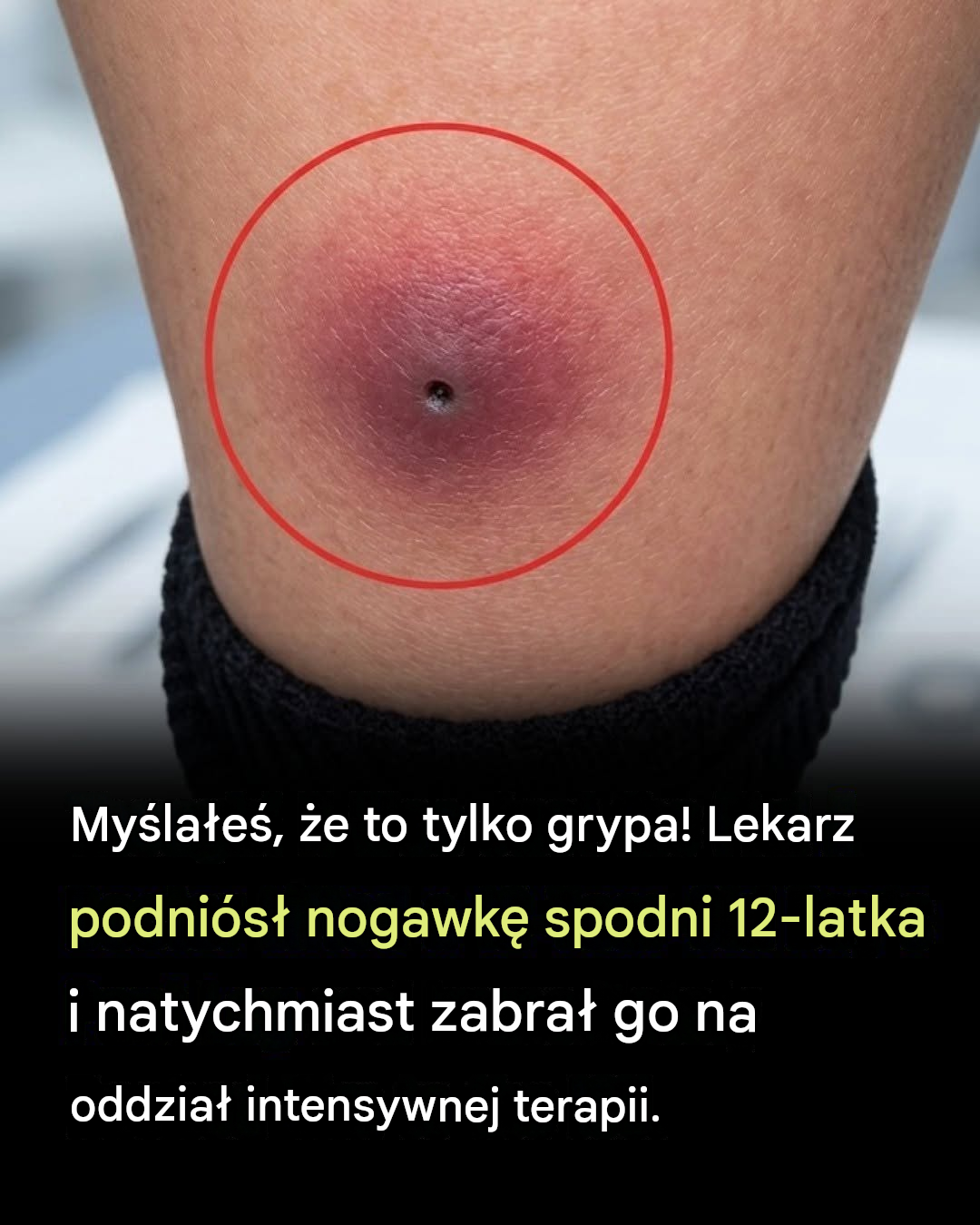 Mała plamka na skórze stała się nagłym przypadkiem wymagającym interwencji medycznej: dlaczego poważnych infekcji skóry nigdy nie należy ignorować