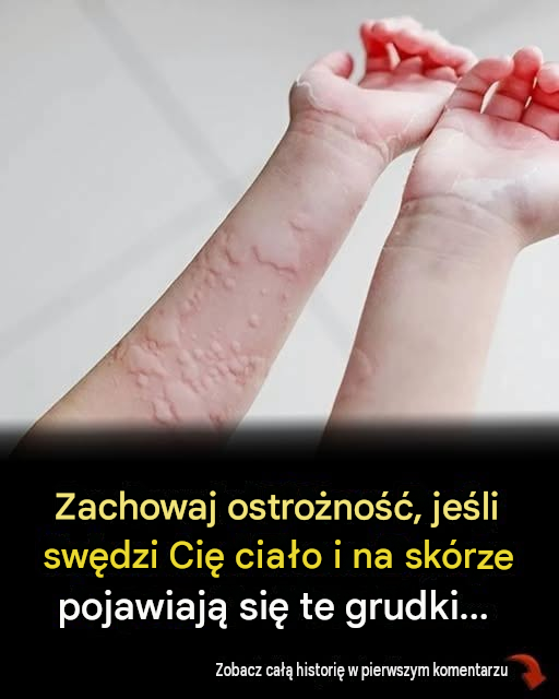 8 zaskakujących czynników wywołujących pokrzywkę, które możesz przeoczyć