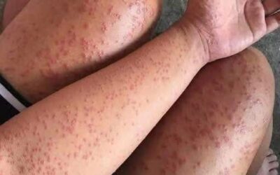 Wysypka skórna z problemami z oddychaniem? To może być zagrażająca życiu reakcja alergiczna.